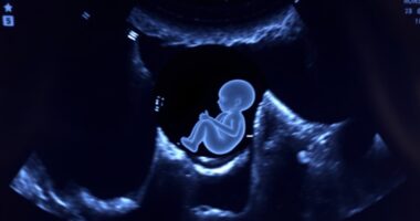 subchorionic hematoma pregnancy risks