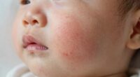 postpartum skin sensitivity burn