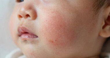 postpartum skin sensitivity burn